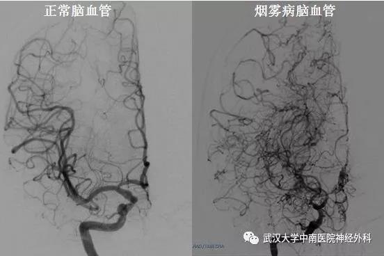 慢性进展性的缺血性脑血管病,因患者脑血管造影影像类似于烟雾而著名