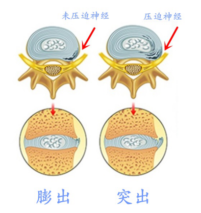 门诊中有患者拿着片子咨询,腰椎间盘膨出是怎么回事?