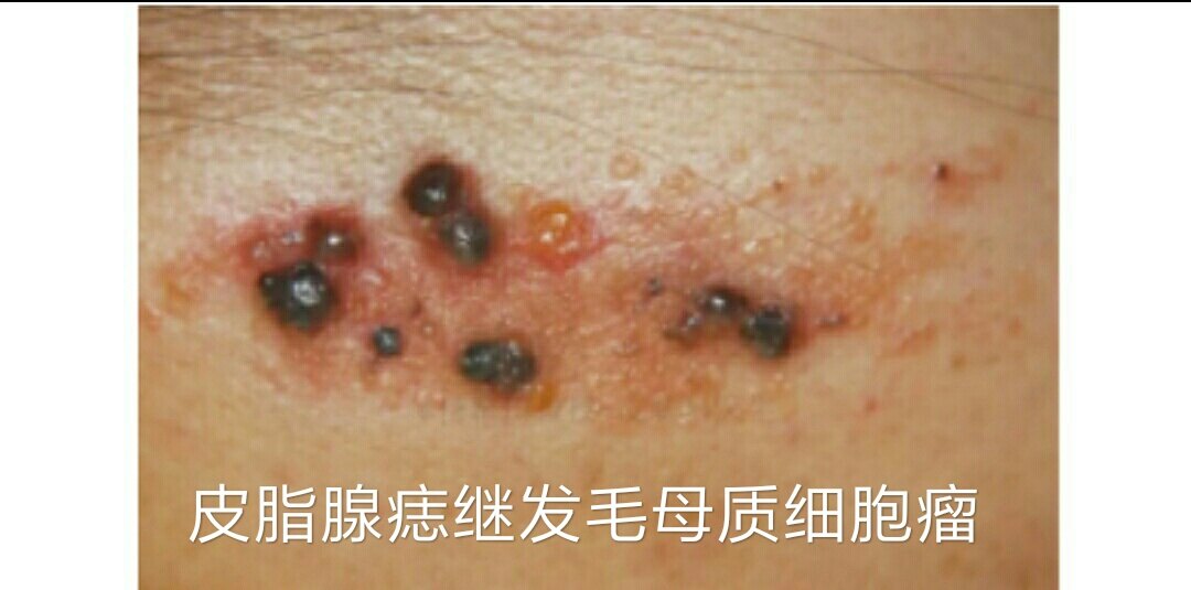 皮脂腺痣简述