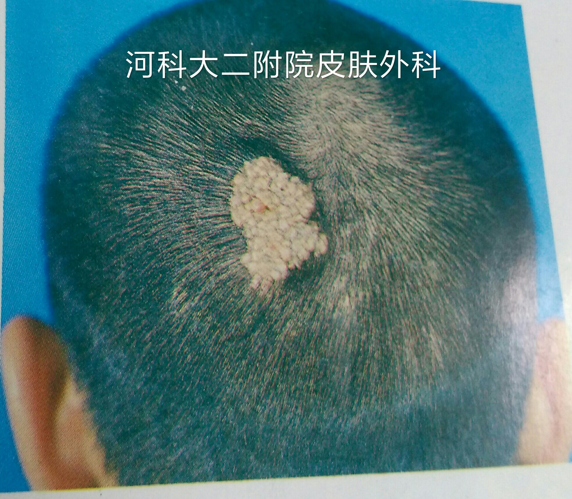 发生于头皮时,皮脂腺痣表面无毛发生长.