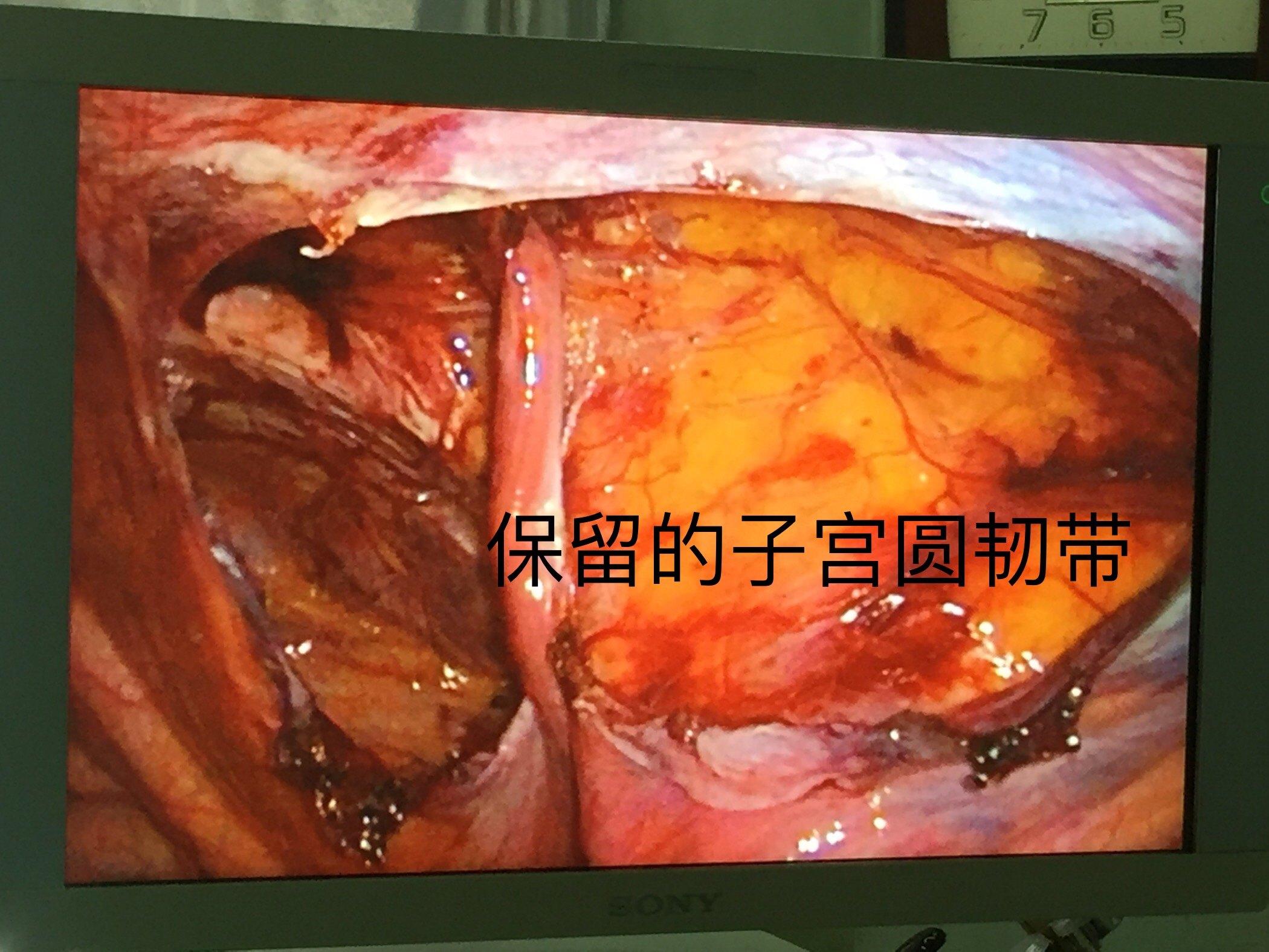 保留子宫圆韧带的女性腹腔镜疝修补新术式