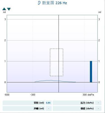 声导抗图显示鼓膜呈b型曲线.