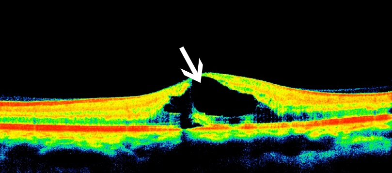 oct:黄斑区囊样水肿,水肿区呈黑色三角型
