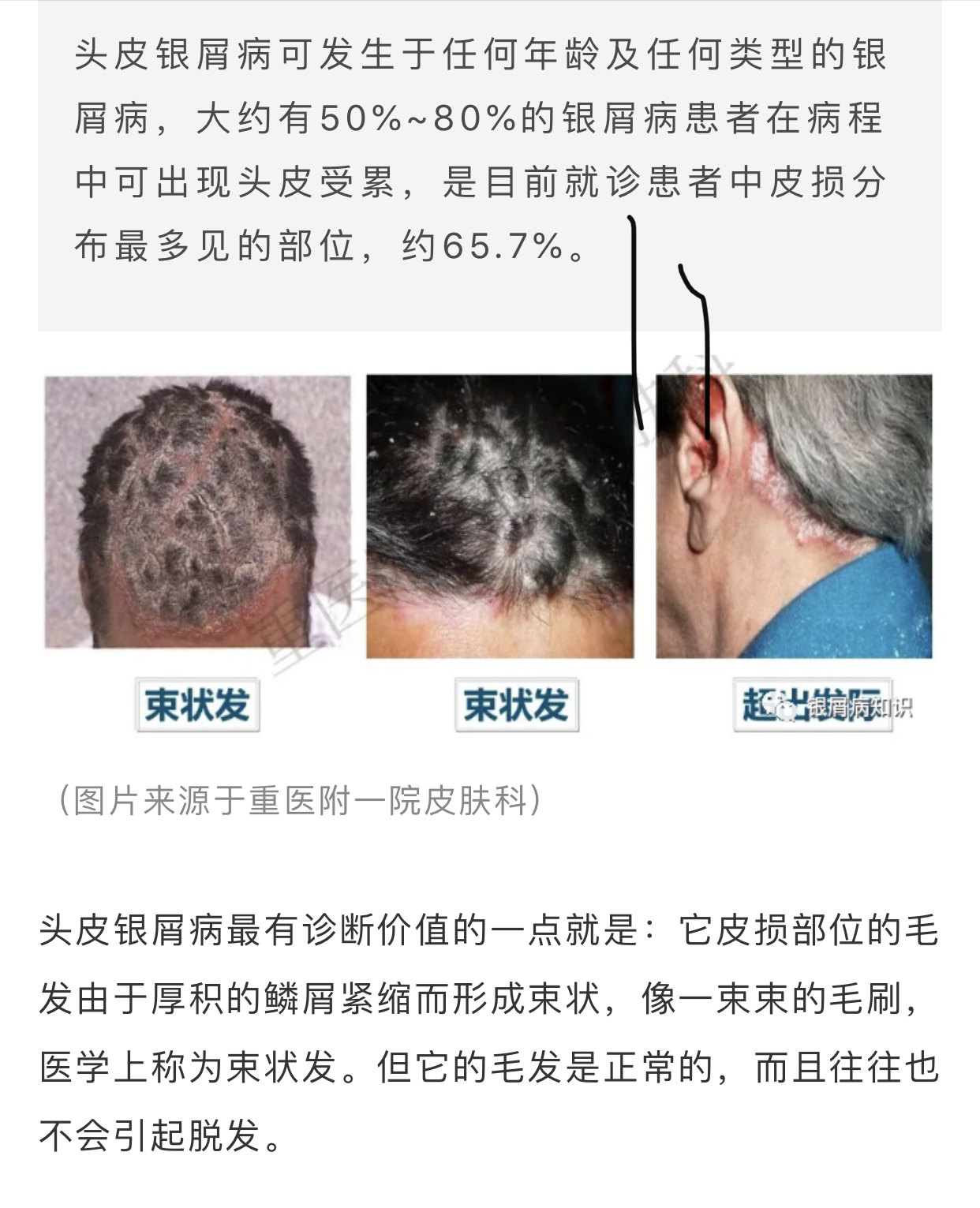 头皮是银屑病患者皮损初发最常见的部位