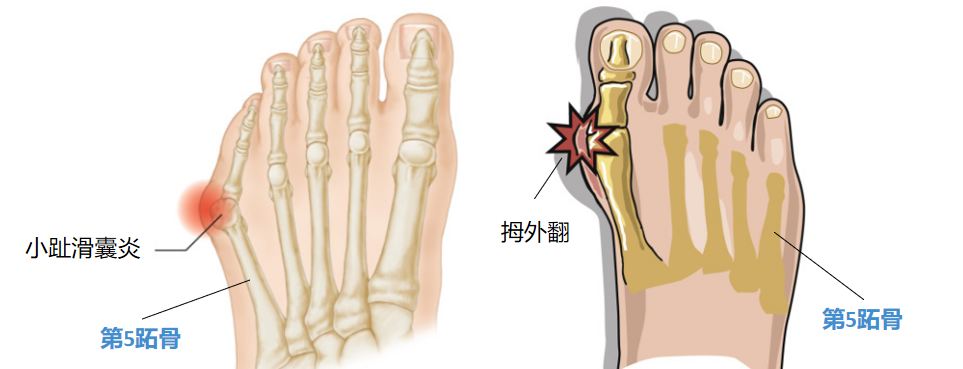 通常表现为小趾内翻,外侧突出形成滑囊并