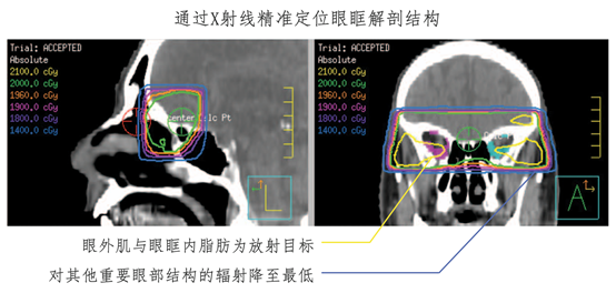 graves眼病系列病例③眼眶放射治疗