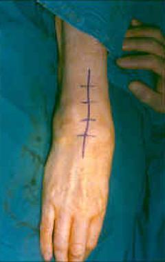 手腕部疼痛的一个常见原因:腕部滑膜炎