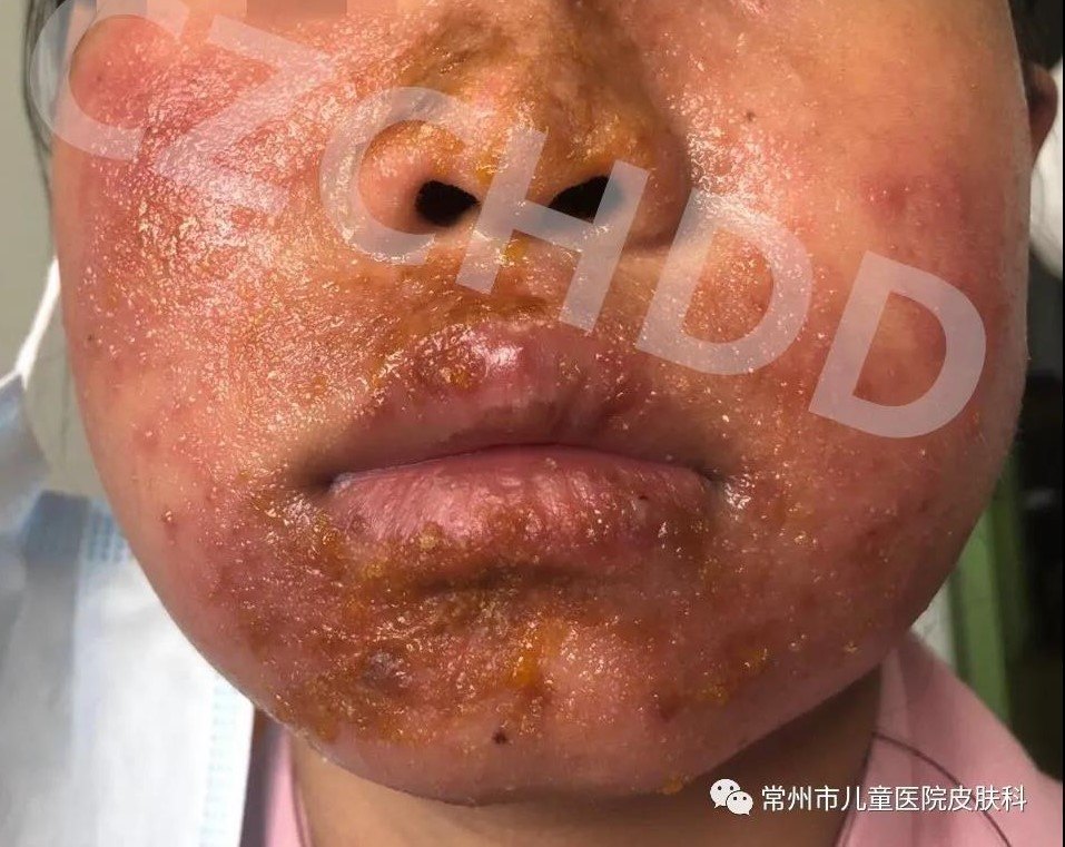 这是比较严重的芒果唇炎,并且累及了面部皮肤.