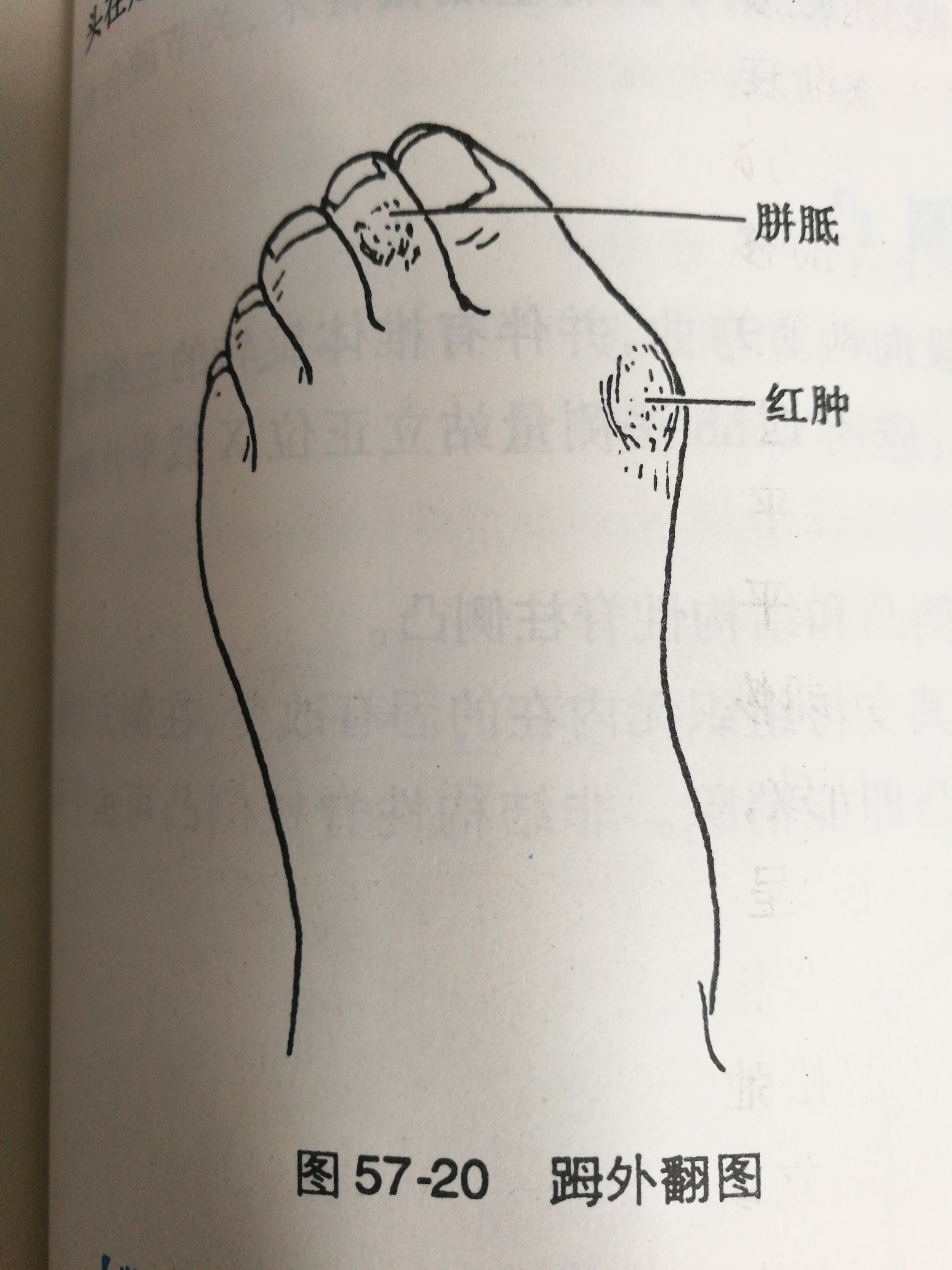 一,踇外翻定义 踇外翻,俗称