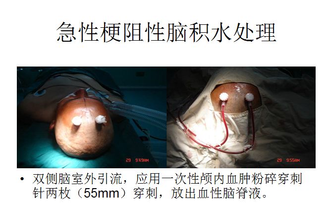 微创穿刺脑室外引流抢救急性梗阻性脑积水