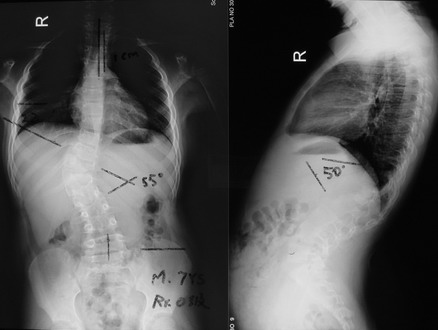 脊柱侧弯典型病例6_先天性脊柱侧弯-半椎体畸形
