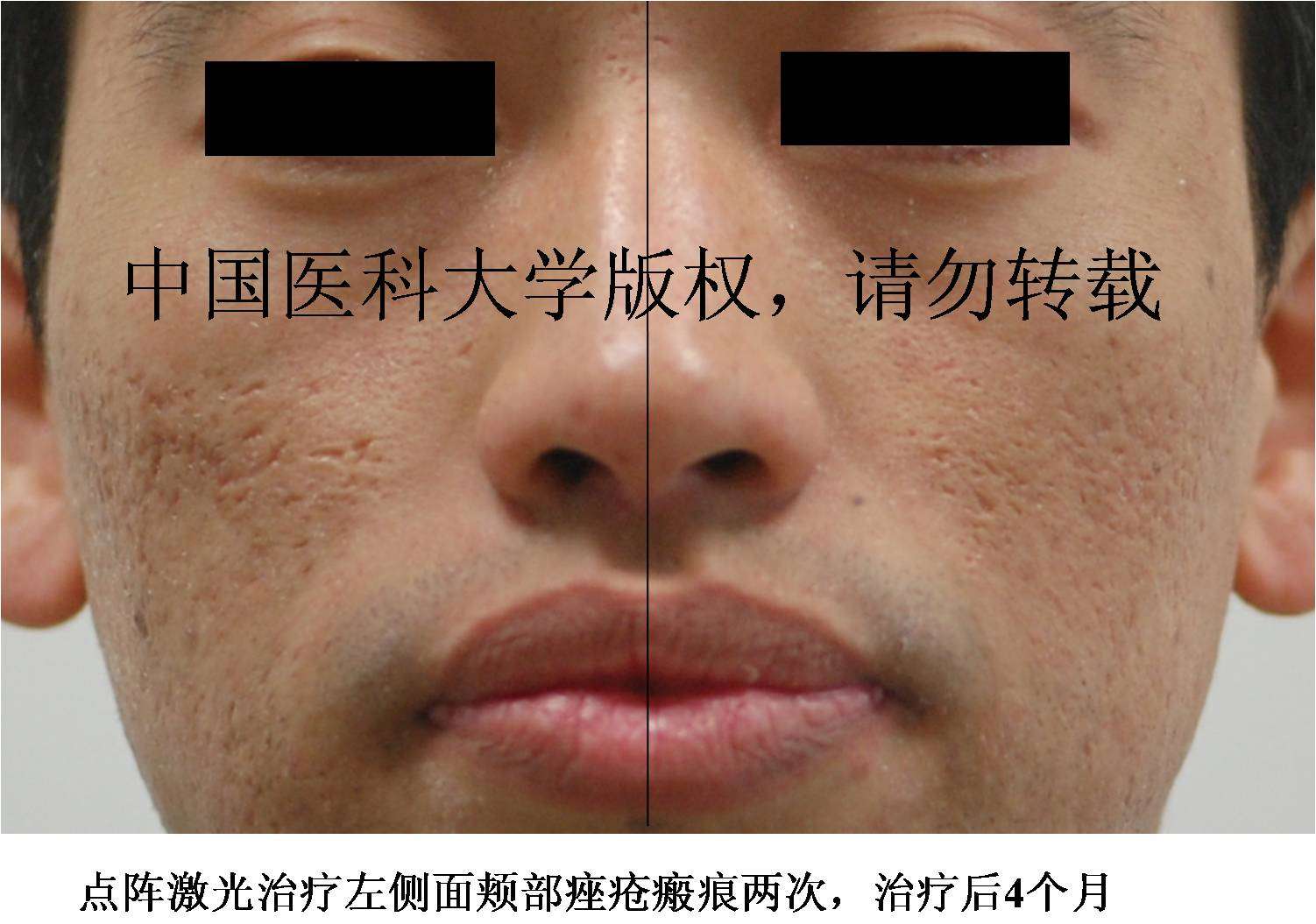 点阵激光治疗痤疮瘢痕及持久性红斑