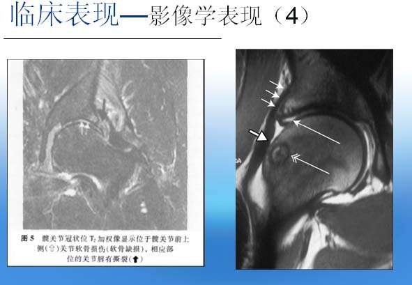撞击综合症2