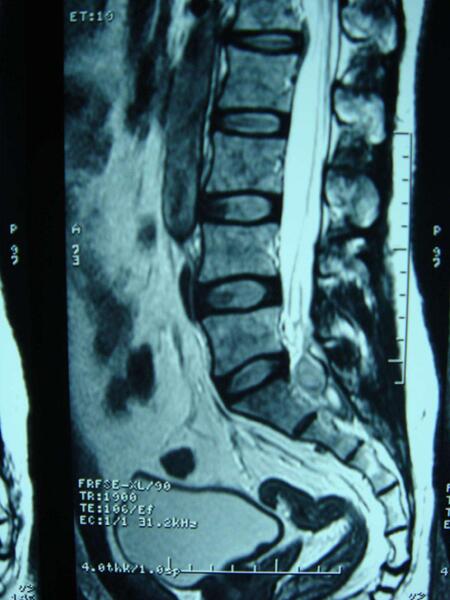 骶尾部 疼痛 2 月.