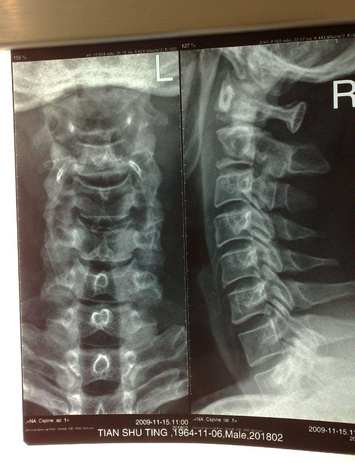 一期后路寰椎侧块枢椎椎板螺钉固定前路病灶清除术治疗枢椎langerhan