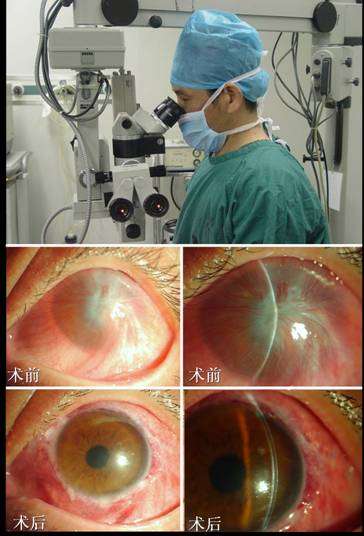 角膜移植术前术后注意事项