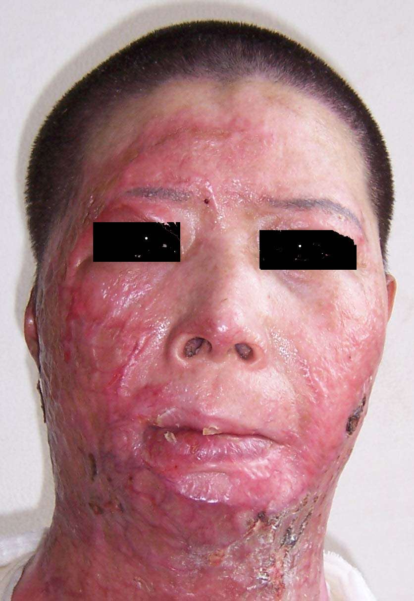 面部疤痕的防治(4)
