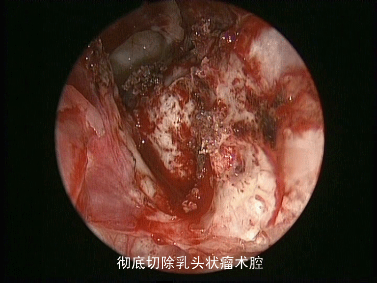 低温等离子刀切除鼻腔鼻窦内翻性乳头状瘤附2例手术图片