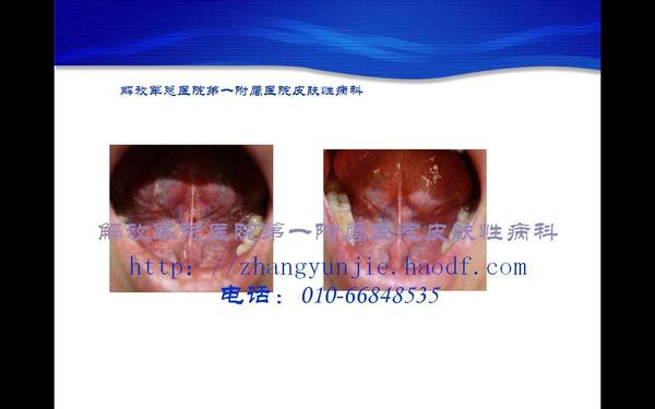 口腔内尖锐湿疣治疗前后(图片) - 好大夫在线