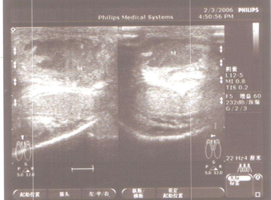 超声诊断阴茎海绵体断裂1例