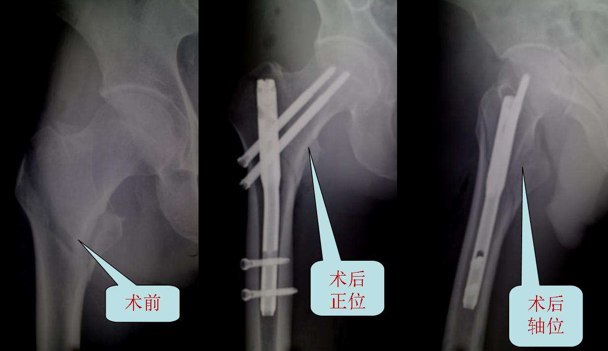 股骨粗隆间骨折重建钉内固定