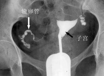 输卵管阻塞疏通术