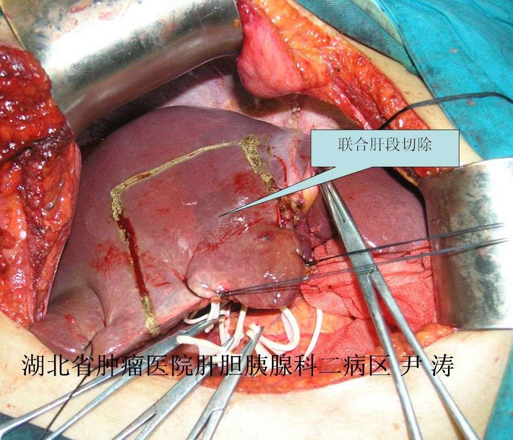 手术进程及高清图片:意外胆囊癌二次手术行扩大根治术