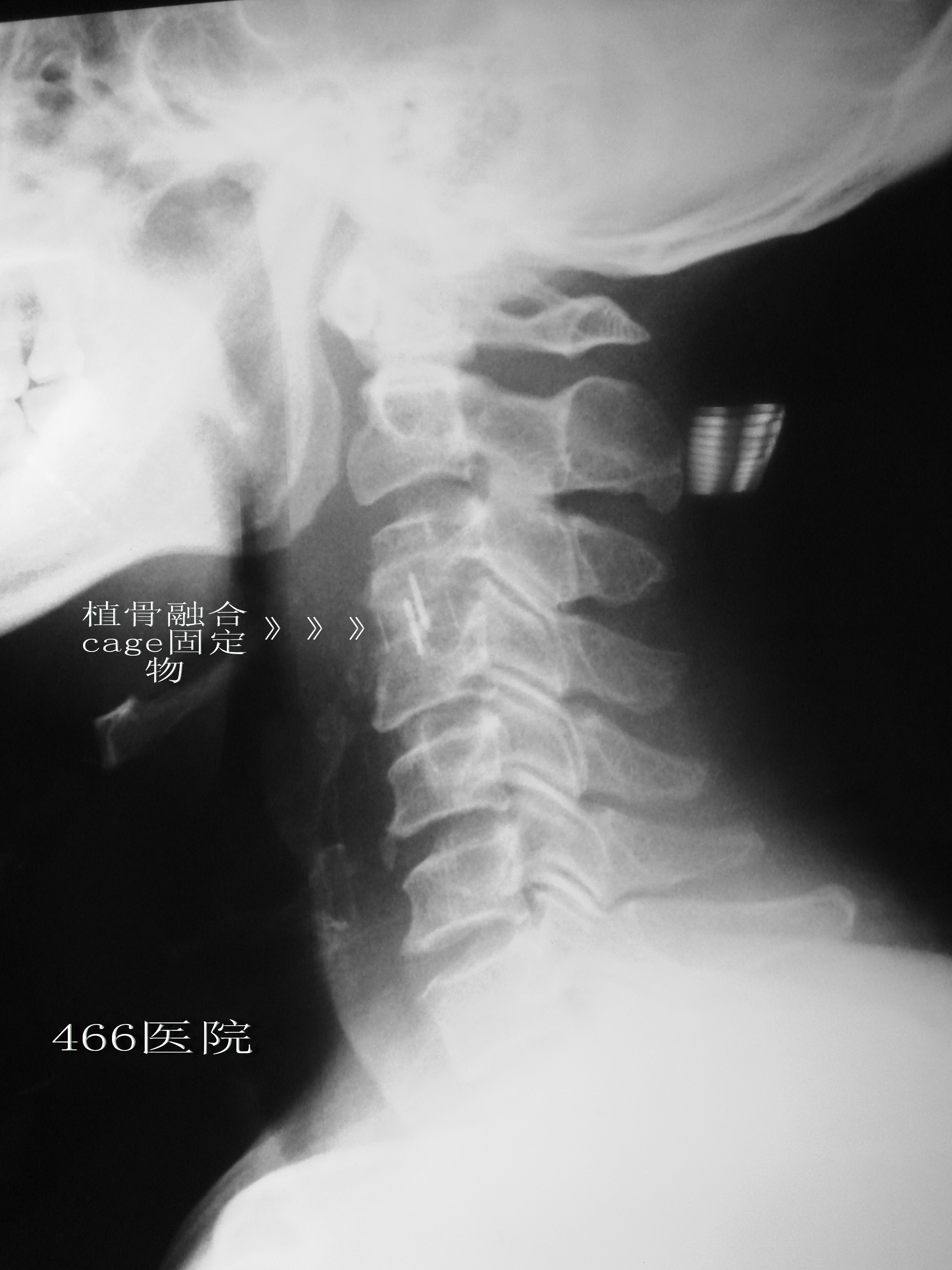 术后颈椎mri:颈3-4椎间盘压迫完全解除,脊髓恢复正常形态.