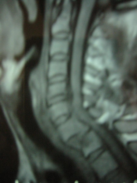 手术治疗下颈椎损伤并发脊髓损伤疗效及预后观察