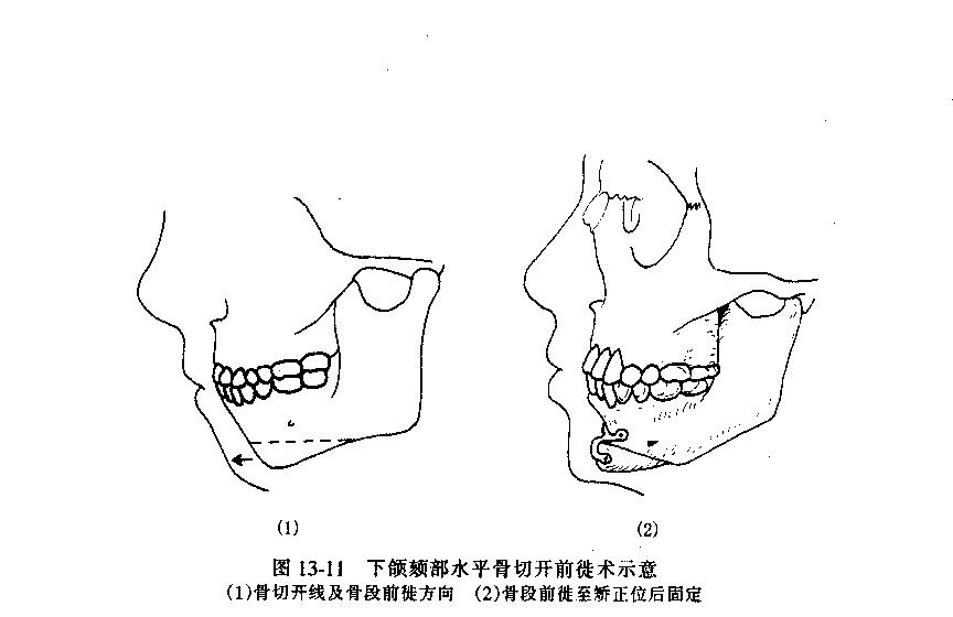 金骥博士剖析:小颏(下巴)手术