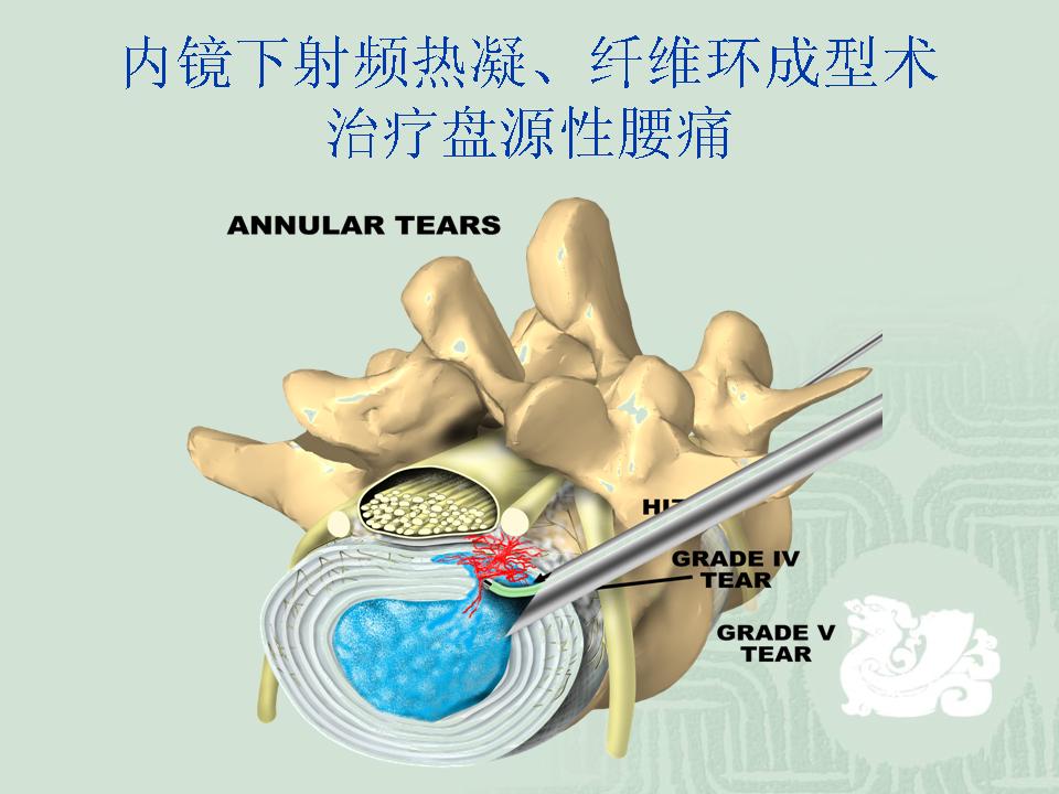 内镜下射频热凝,纤维环成型术治疗椎间盘源性腰痛