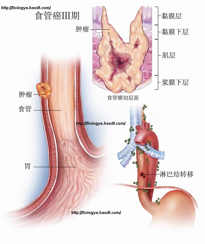 完成后,缓解一段时间又出现的食管癌,可复发与食管或身体的其他部位