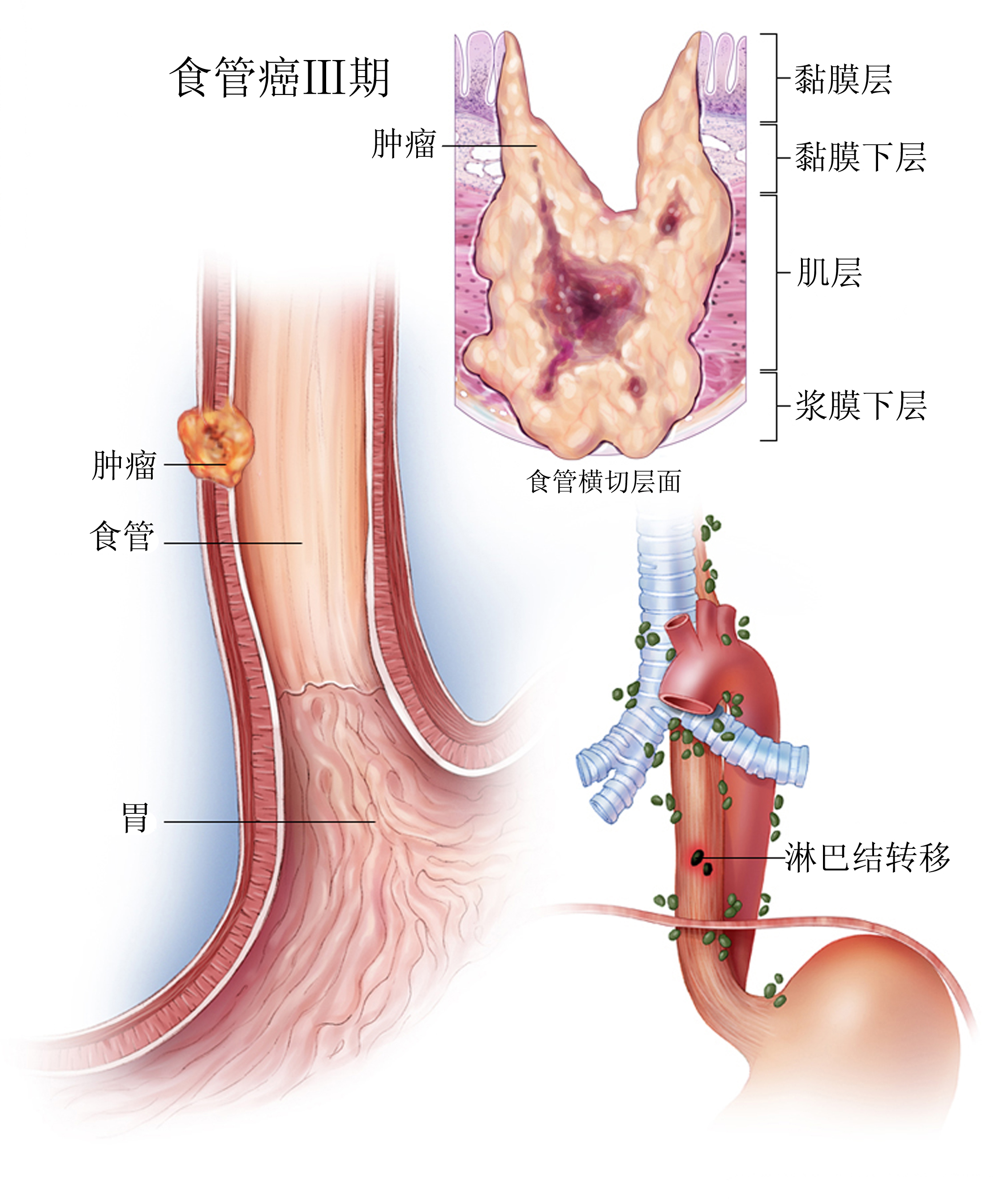 食管癌 (图文,科学普及版)