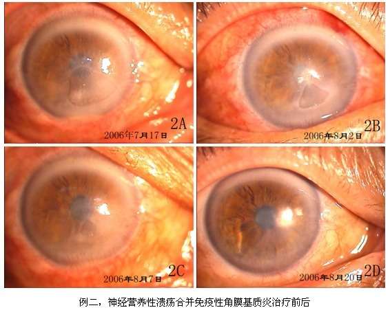 特殊类型单纯疱疹病毒性角膜炎的临床诊治