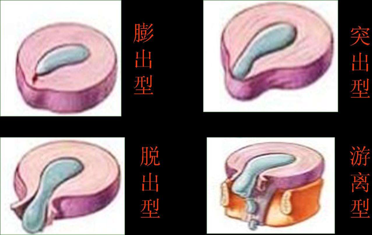腰椎间盘突出症的临床分型有哪些?