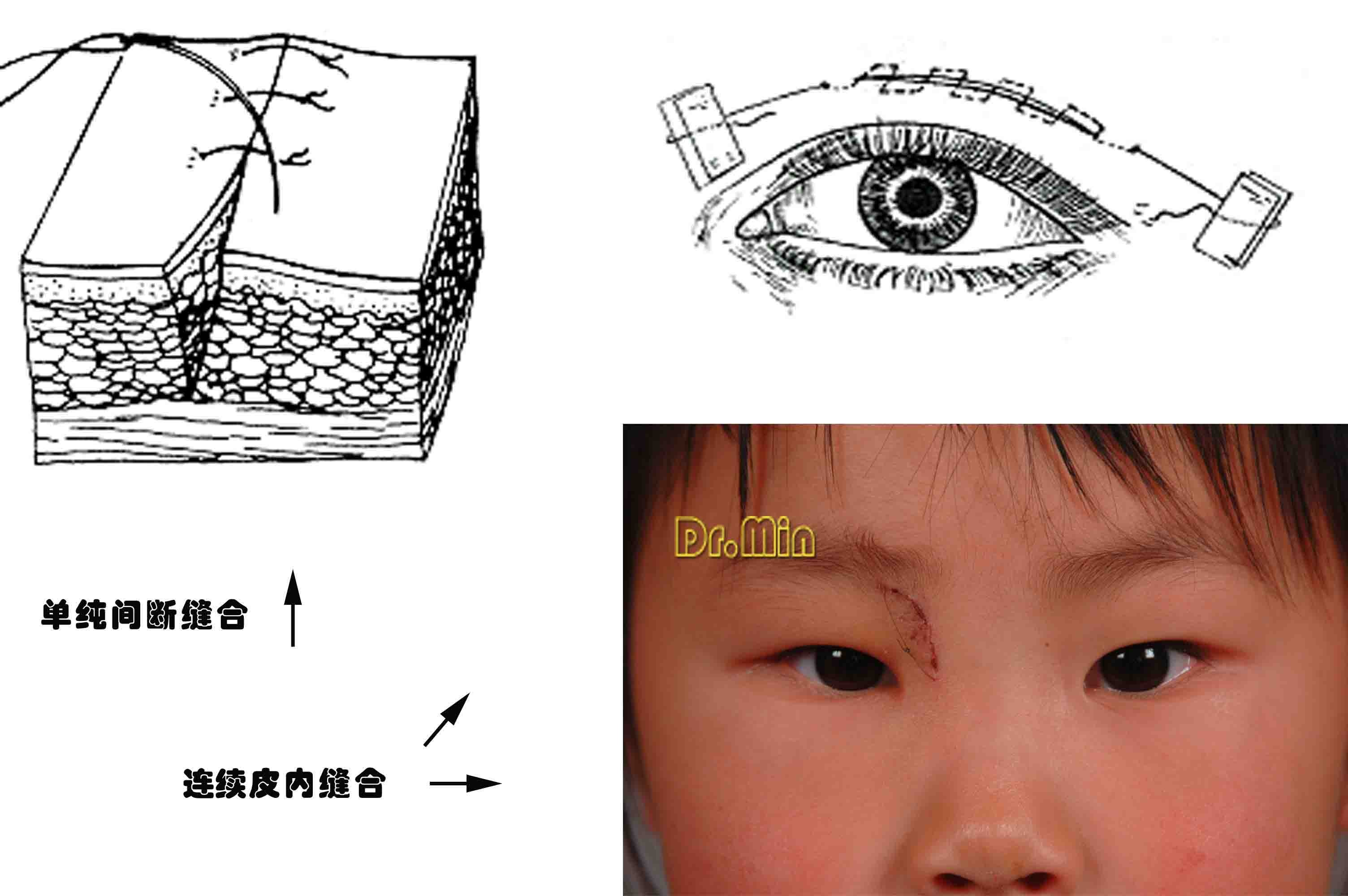 右下图小患者的右眼鼻上方长了一个 肿瘤 ,切除后采取皮内缝合,目前是