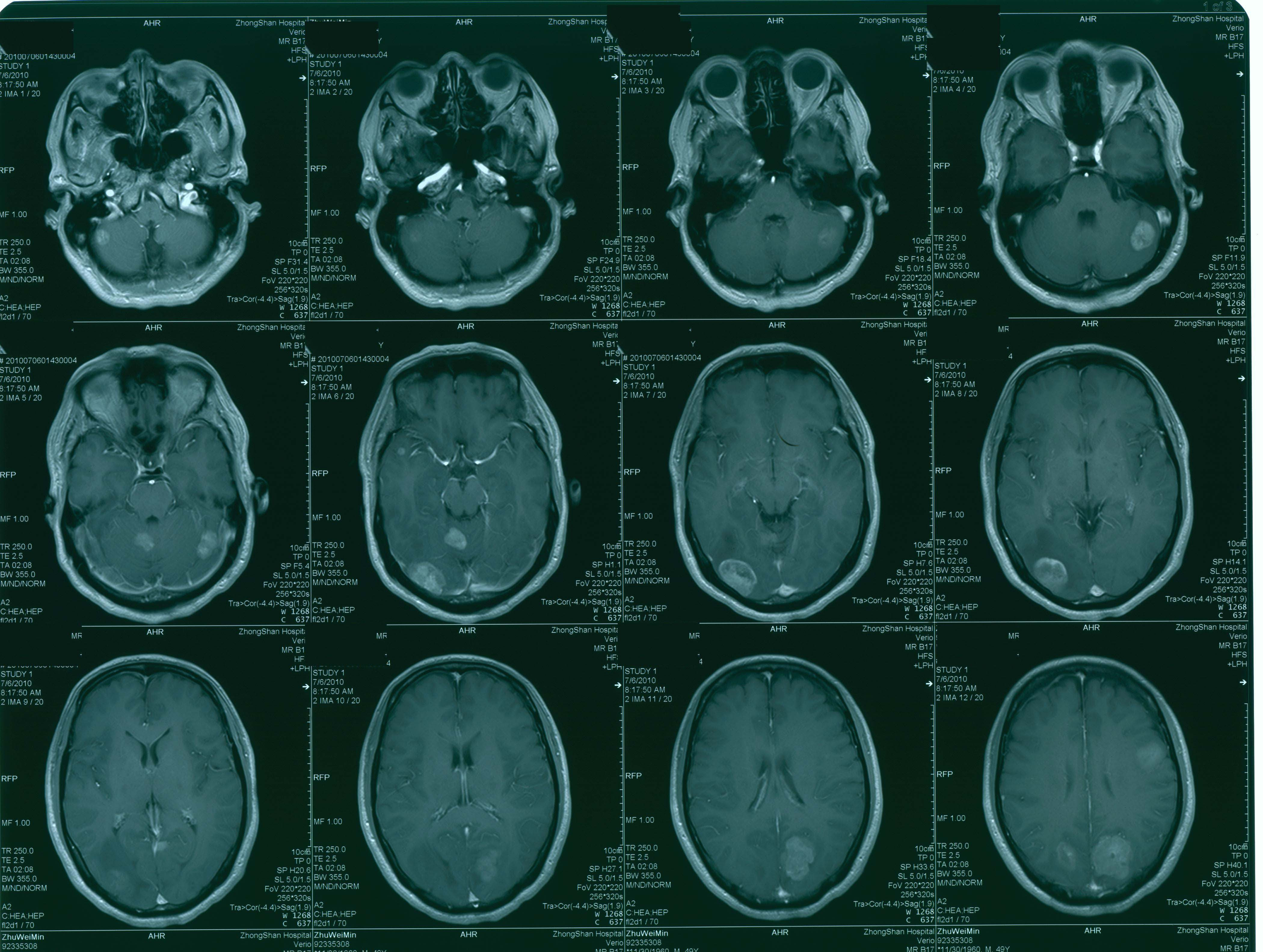 头部磁共振(mri)检查发现脑内多发转移瘤,肺部ct检查发现 肺癌