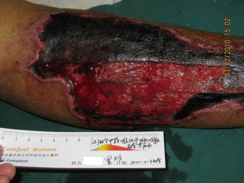 负压伤口治疗新技术治愈1例药物外渗导致小腿大面积坏死伤口