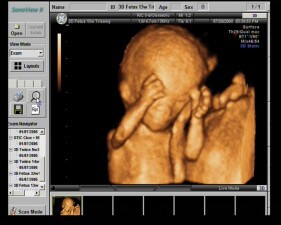 四维彩超胎儿正常图片1