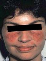 盘状红斑狼疮皮疹:局限型皮疹仅累及头面部.