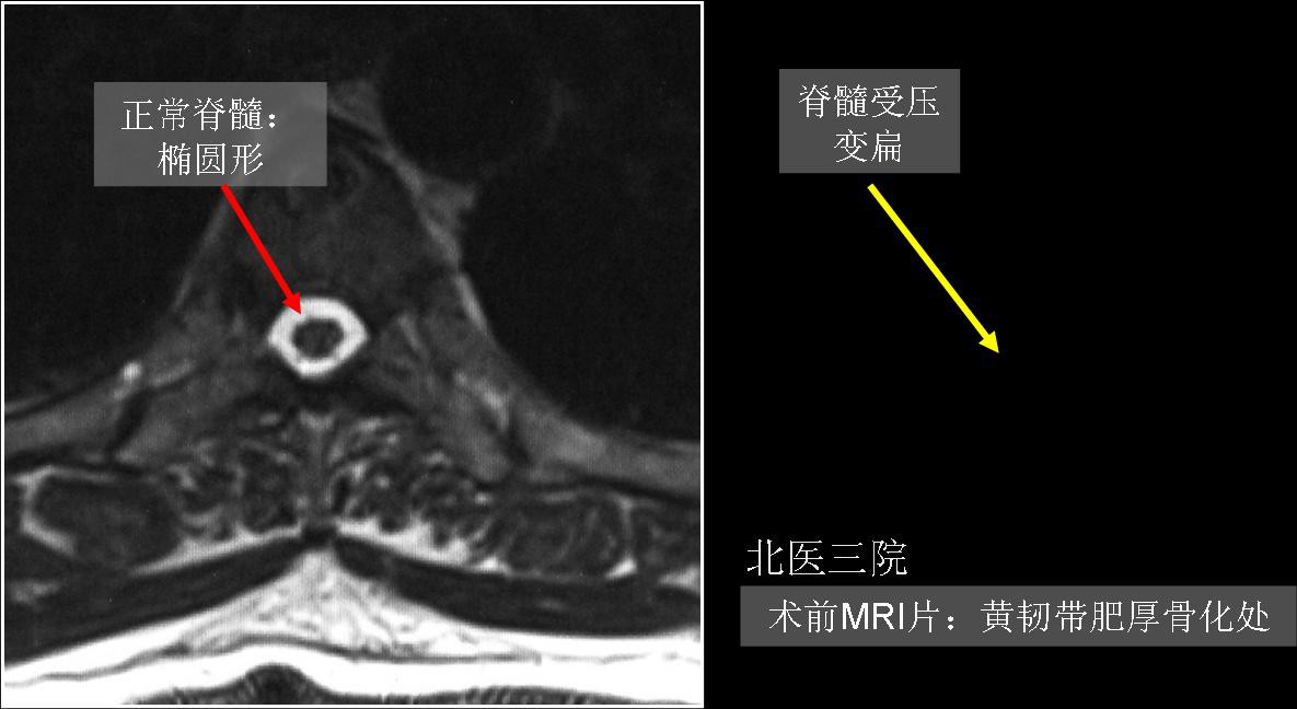 纵断面的mri(下图左侧)和ct(下图右侧)检查显示:胸椎黄韧带骨化 肥厚