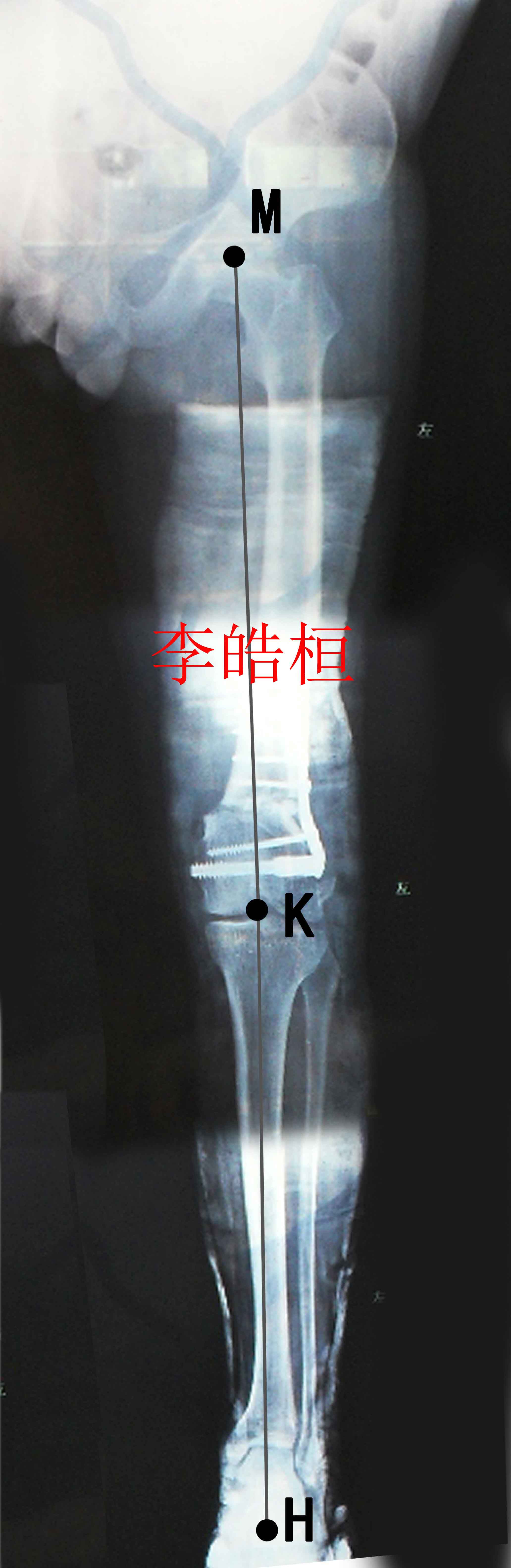 膝关节畸形矫正