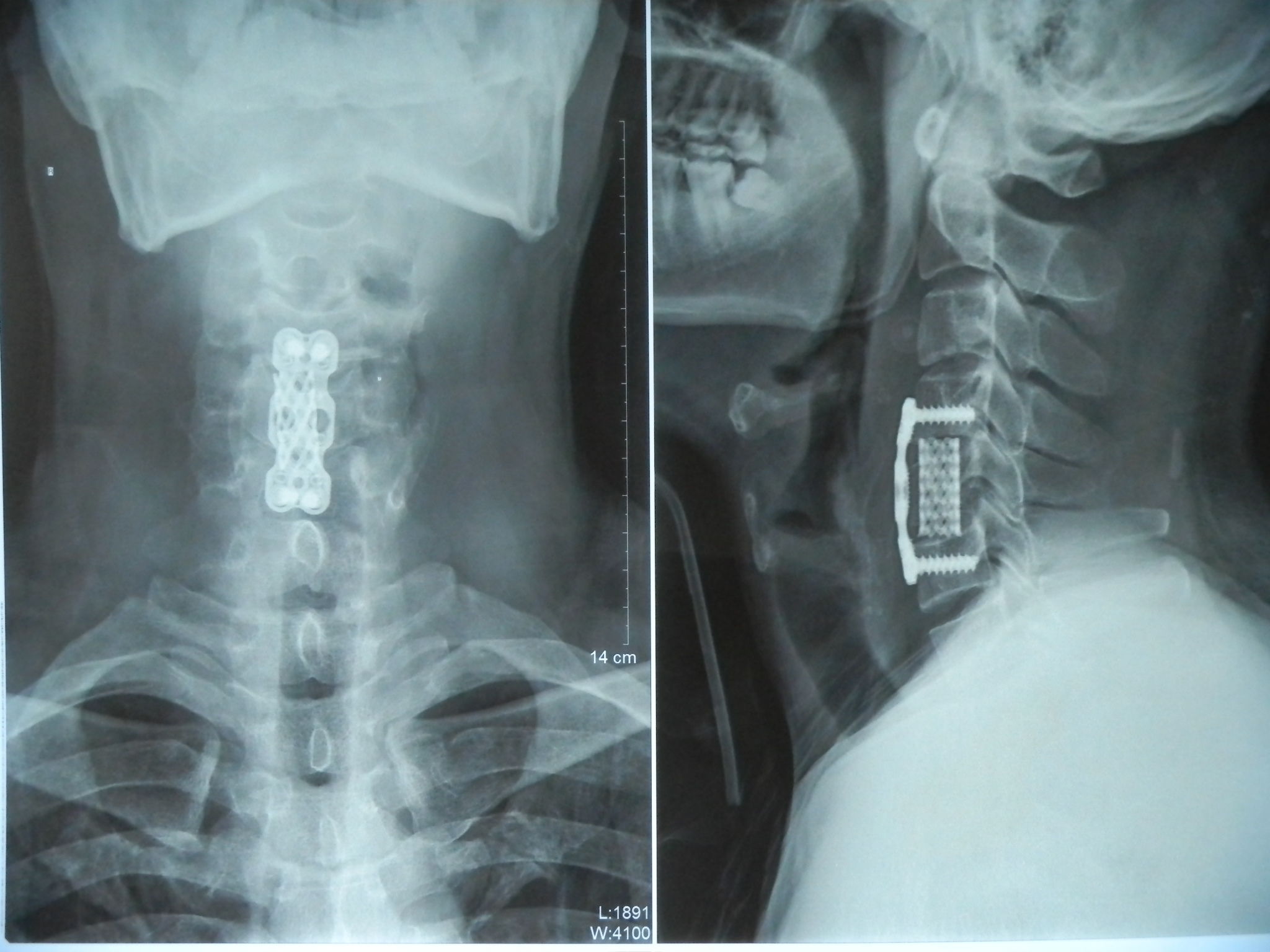 颈椎x光正侧位片显示钛网,钢板位置良好