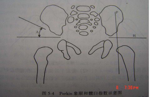 发育性髋关节发育不良(ddh)