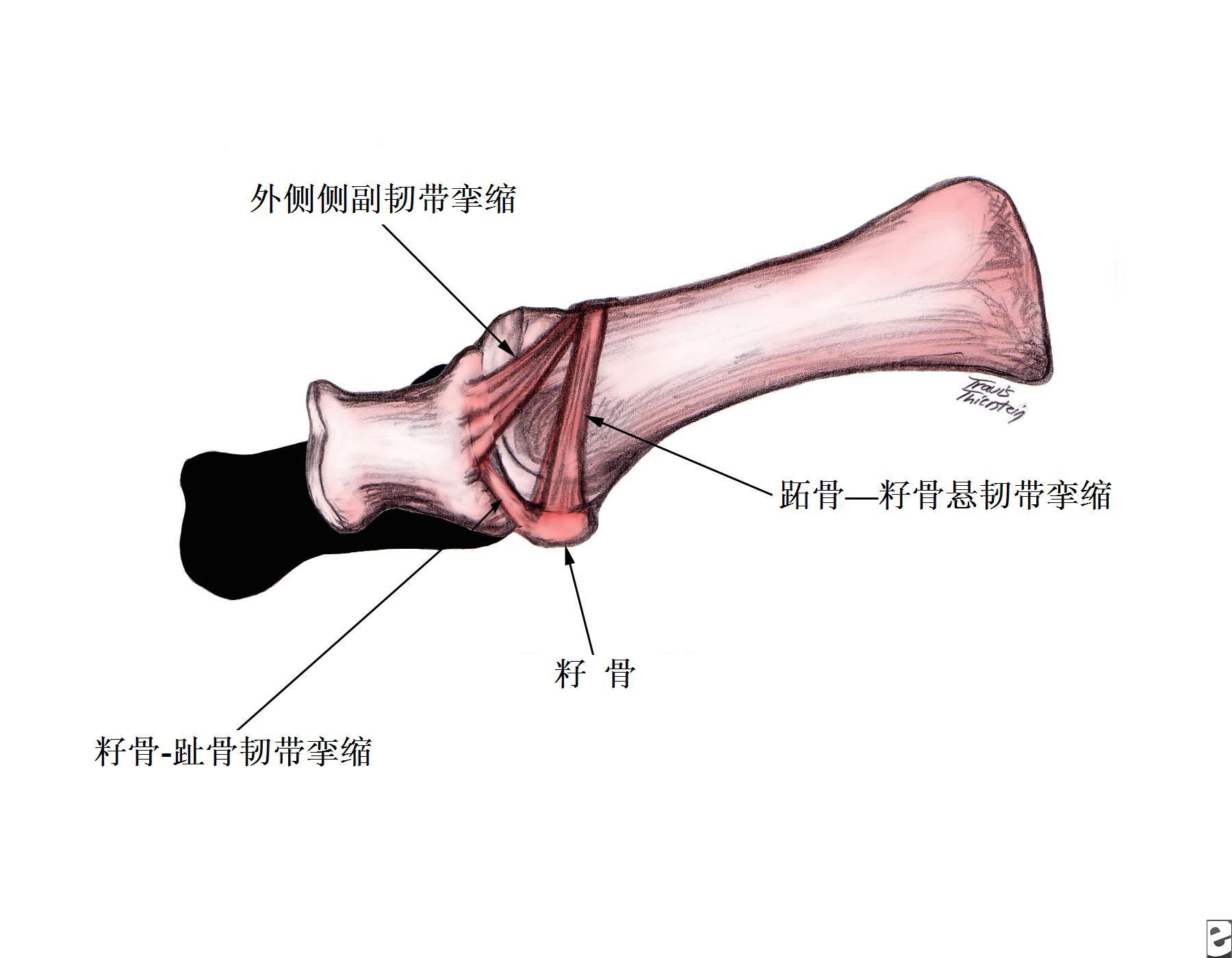 拇外翻跖趾关节外侧软组织改变图示