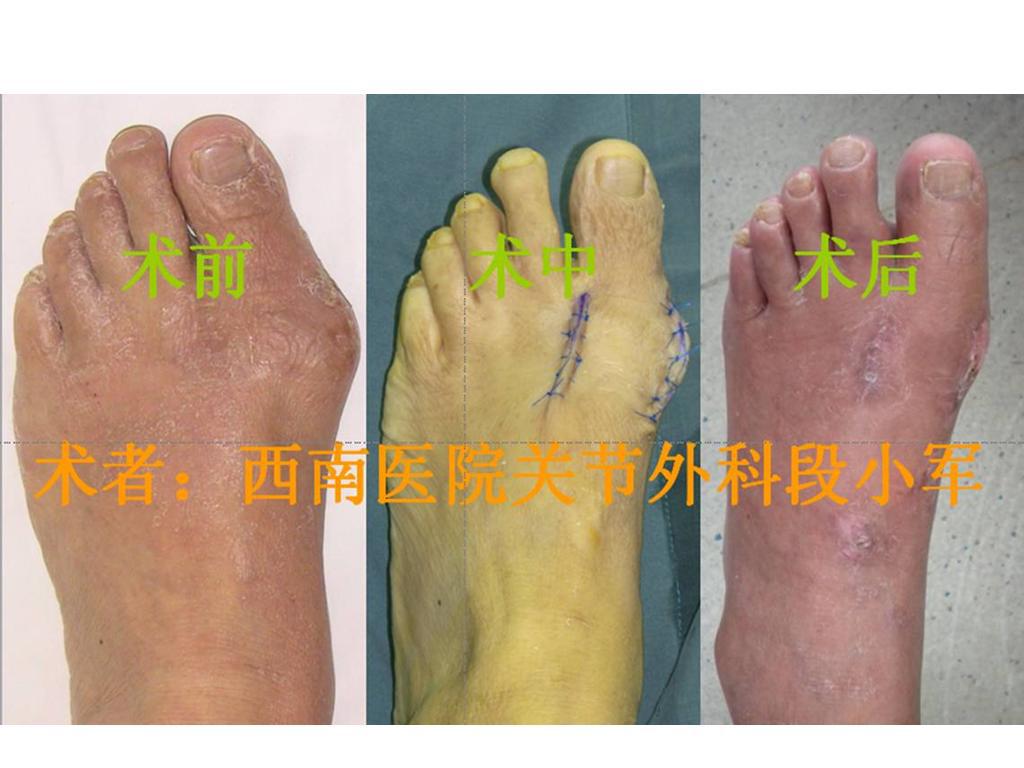 足拇外翻