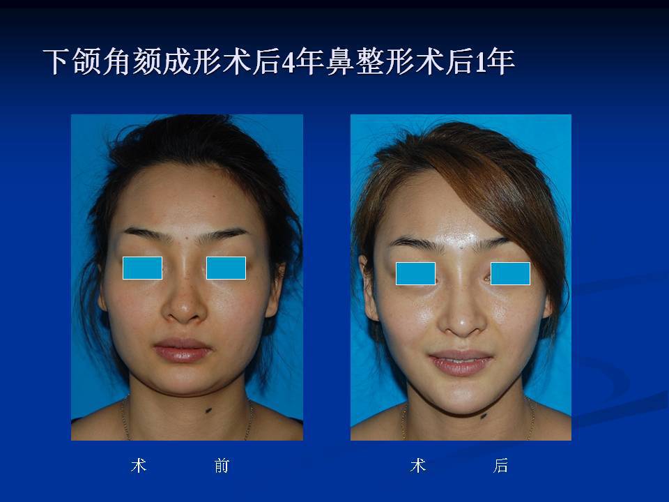 下颌角颏成形术后4年对比照片
