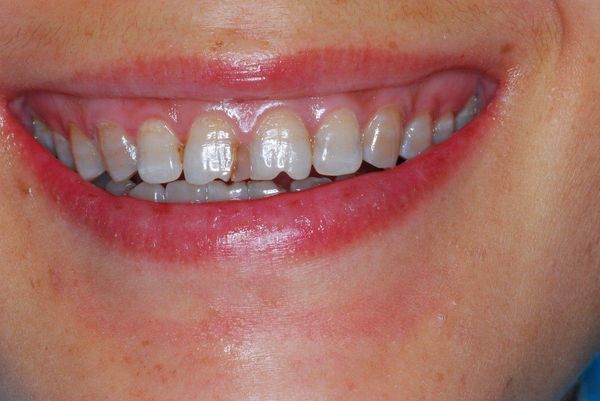 全瓷贴面 美学修复 四环素牙!