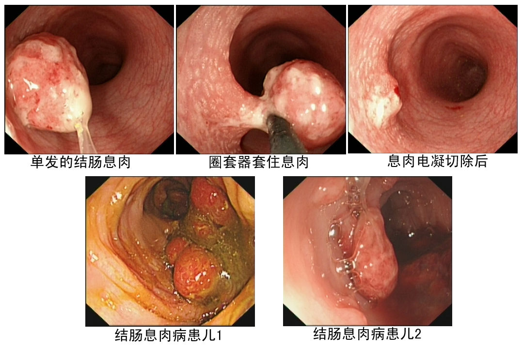 小儿结直肠息肉的检查及治疗