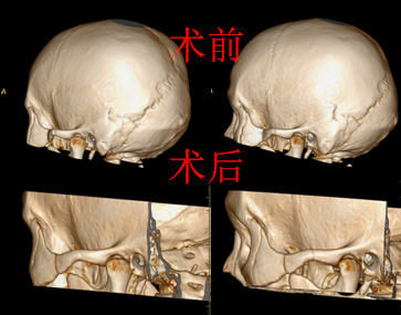 弓 骨折 ,可有一个 骨折 线或多个 骨折 线, 骨折 呈凹陷并向深部移位